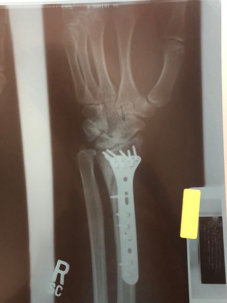 x ray of broken wrist
